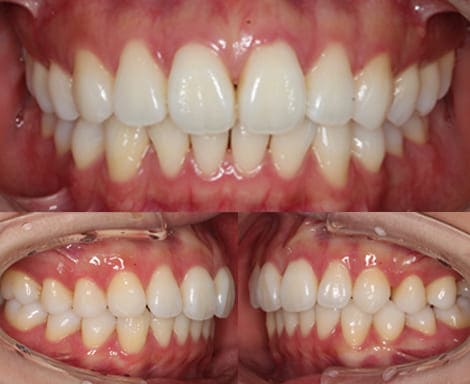 舌側矯正・裏側矯正［非抜歯矯正］正面左右術前