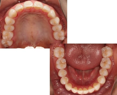 舌側矯正・裏側矯正［非抜歯矯正］咬合面術後