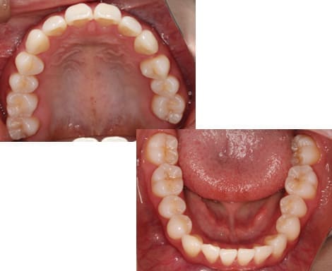 舌側矯正・裏側矯正［非抜歯矯正］咬合面術前
