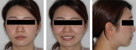 舌側矯正・裏側矯正［非抜歯矯正］顔貌術後