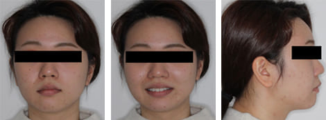 舌側矯正・裏側矯正［非抜歯矯正］顔貌術前