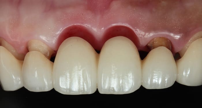 オベイトポンティック治療後