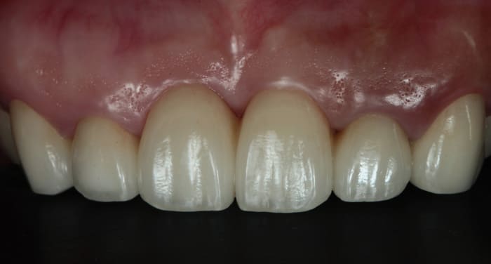 オベイトポンティック治療後