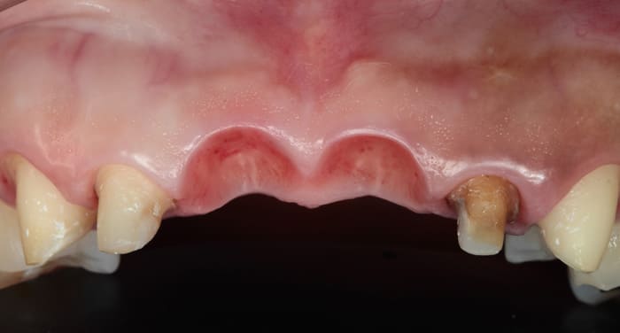 オベイトポンティック治療前