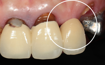 オベイトポンティック前