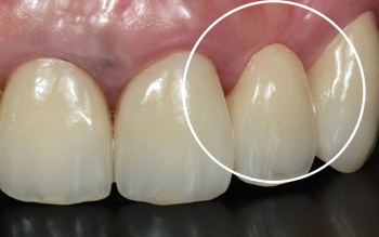 オベイトポンティック後