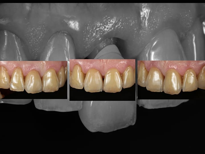 プロフェッショナルな白い歯