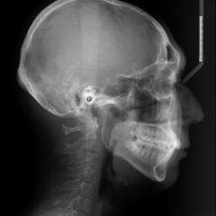 歯科用ＣＴスキャンと矯正歯科治療