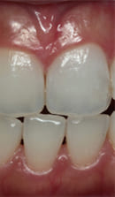 黒ずんだ歯の中からのホワイトニング治療後