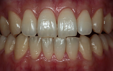 オフィスホワイトニング01治療前