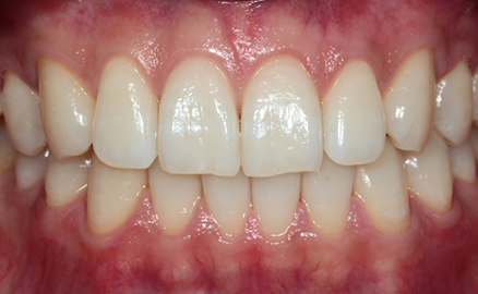 オフィスホワイトニング01治療後