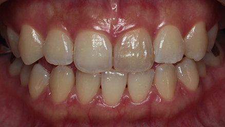 オフィスホワイトニング02治療前