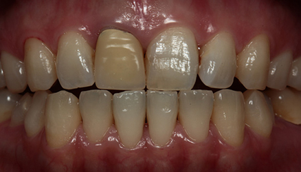 デュアルホワイトニング01治療前