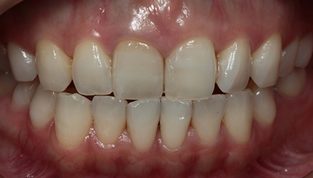 デュアルホワイトニング01治療後