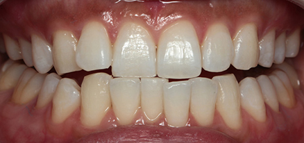 デュアルホワイトニング02治療後