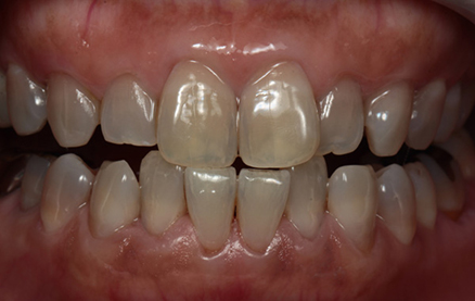 デュアルホワイトニング03治療前