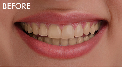 ホームホワイトニング治療前