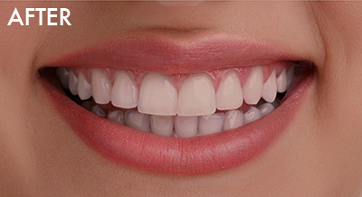 ホームホワイトニング治療後