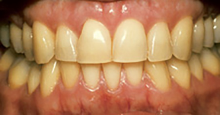 ナイトホワイトエクセル治療前