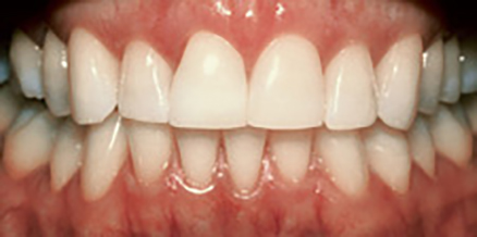 ナイトホワイトエクセル治療後