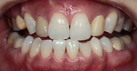 ナイトホワイトエクセル02治療前