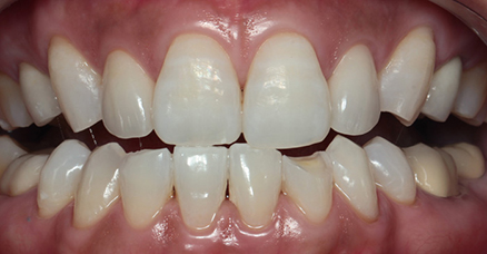 ナイトホワイトエクセル02治療後